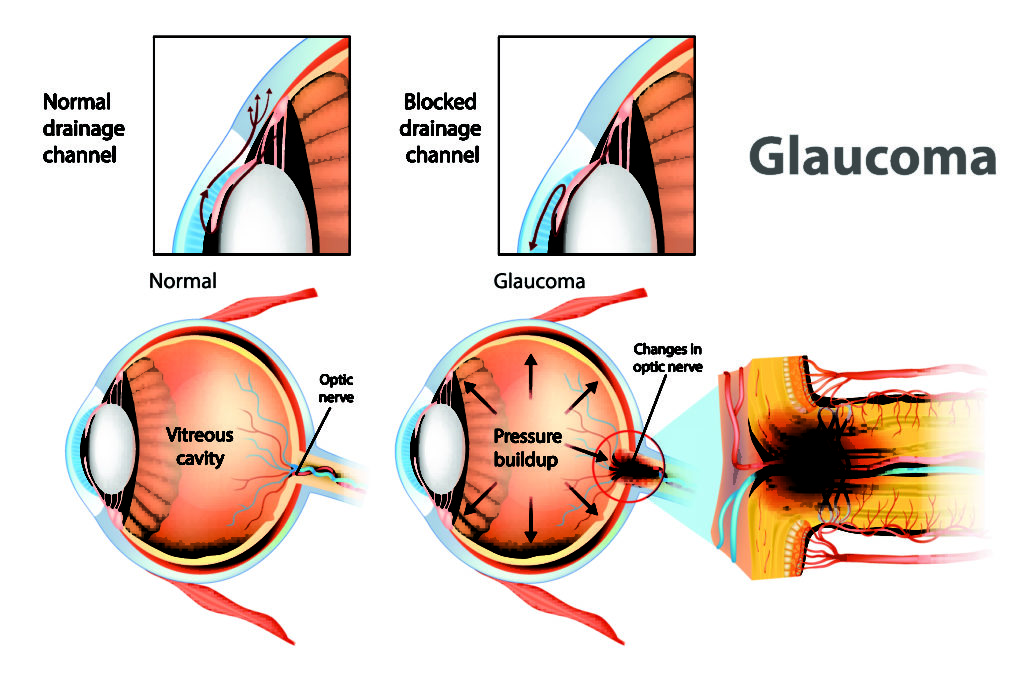 Glaucoma Suspect