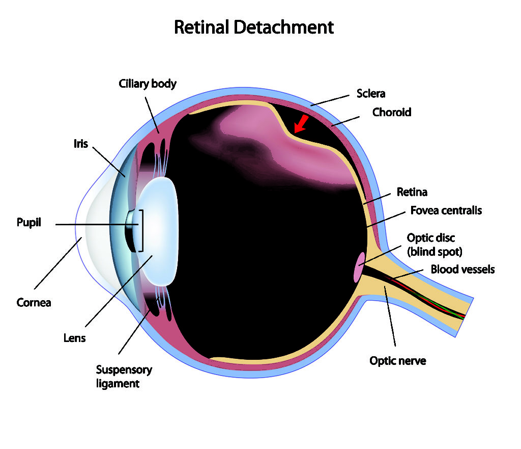 Lattice Retinal Degeneration