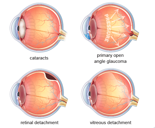 how does myopia affect eye health
