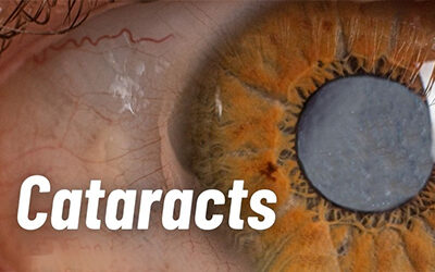 Cataracts: A Common Cause of Blurred and Foggy Vision